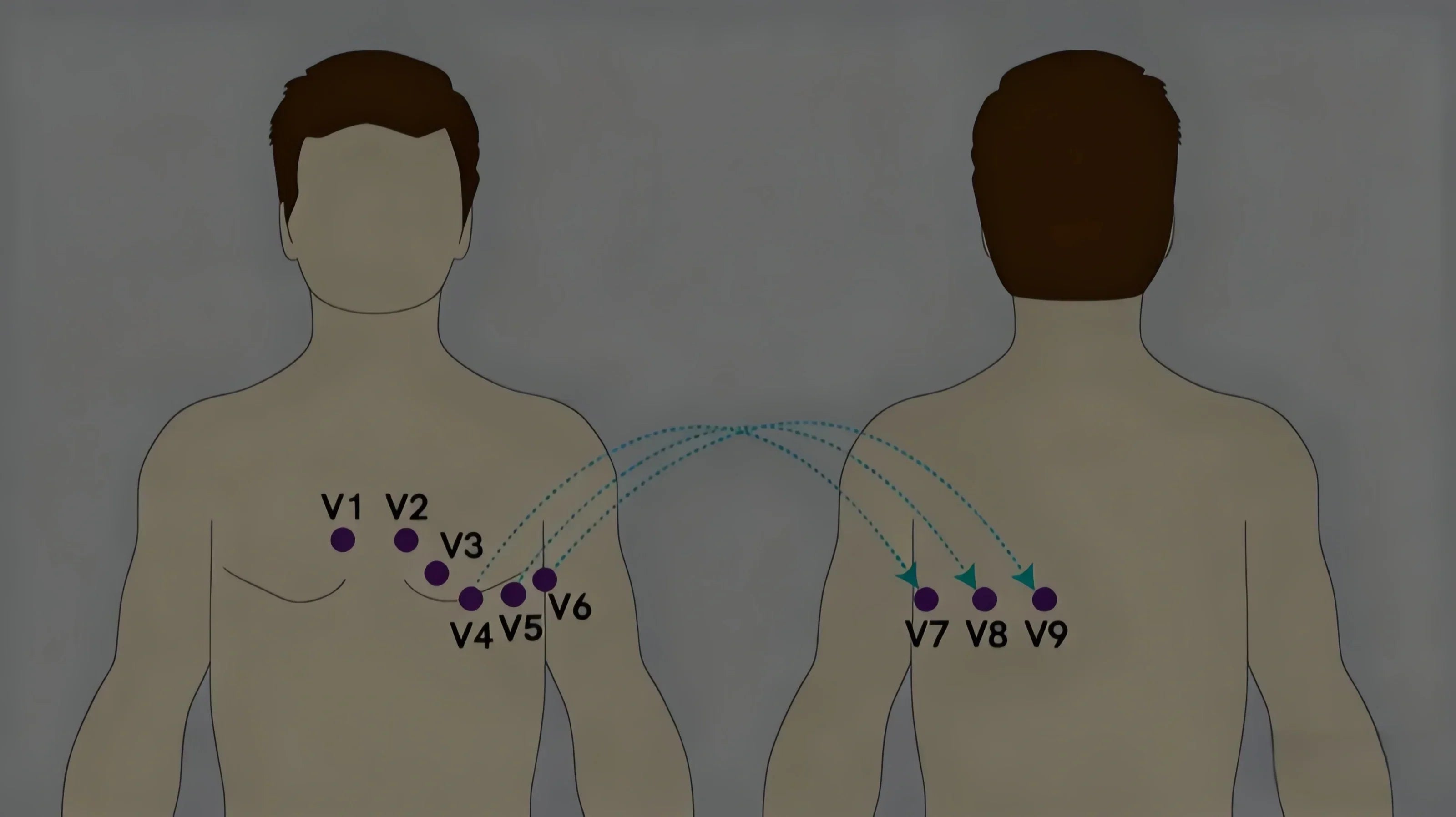 15 Lead ECG Placement Complete Step by Step Guide Extended ECG 15-lead-ecg-placement-complete-step-by-step-guide-extended-ecg